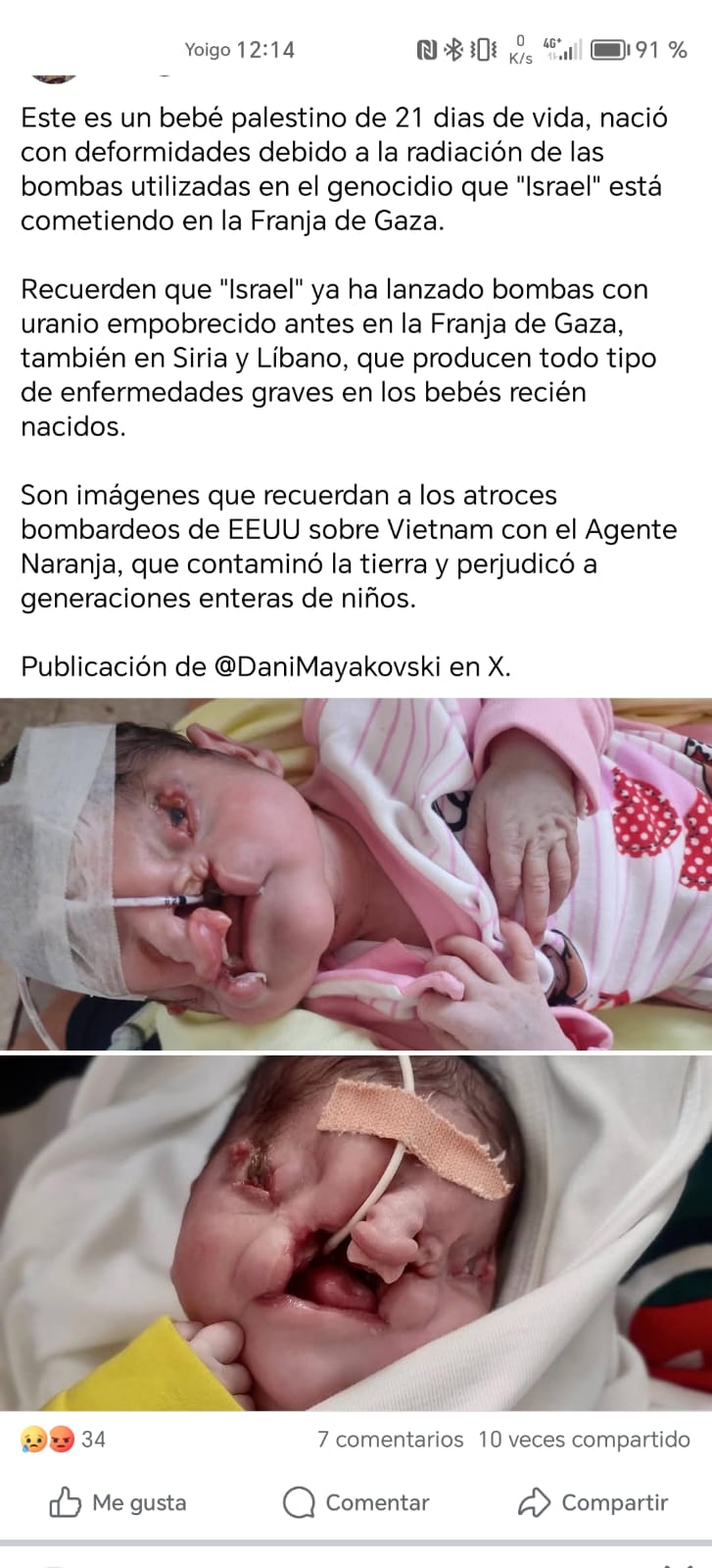 Un bebé palestino nace con deformidades debido a la radiación de las bombas utilizadas en la Franja de Gaza